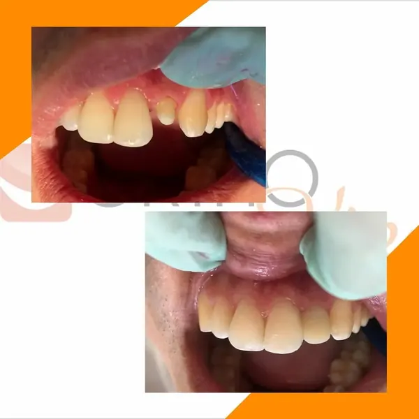 Antes e depois: Reabilitação de dente fraturado após queda