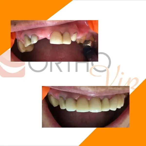 Antes e depois: Reabilitação oral com ponte fixa
