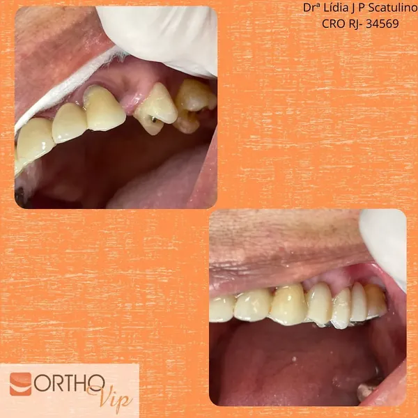 Antes e depois: Ponte fixa para substituir dente ausente