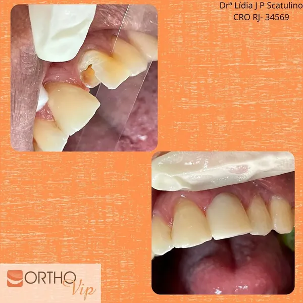 Antes e depois: Reconstrução de dente fraturado com pino de fibra e faceta